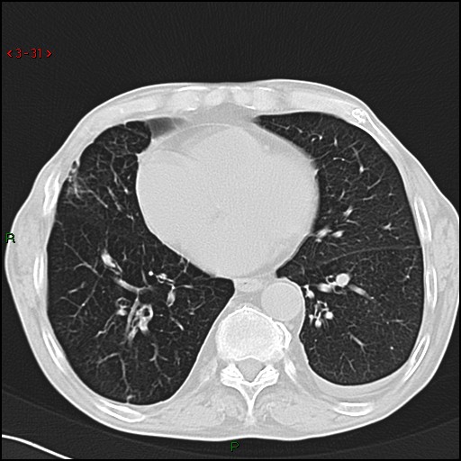 File:Aspergilloma (Radiopaedia 14842-14787 Axial lung window 31).jpg
