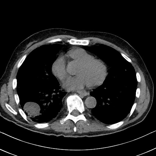 File:Aspergilloma on background pulmonary fibrosis (Radiopaedia 60942-68757 Axial non-contrast 37).jpg