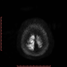 File:Astroblastoma (Radiopaedia 74287-85162 Axial DWI 110).jpg