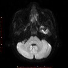 Astroblastoma (Radiopaedia 74287-85162 Axial DWI 20).jpg