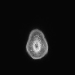 Astrocytoma (Radiopaedia 85660-101440 I 158).jpg