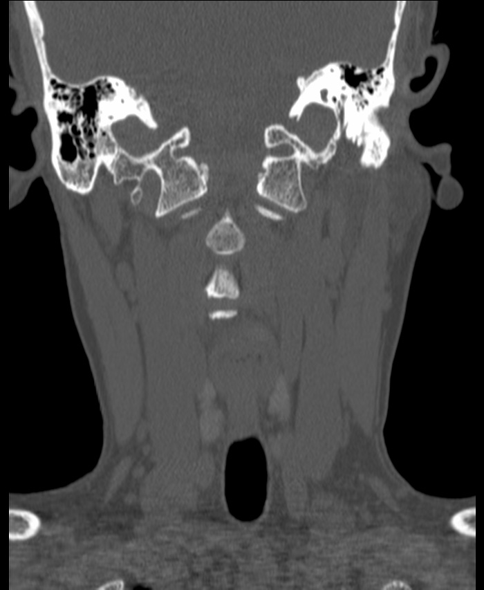 Atlanto-occipital assimilation with basilar invagination (Radiopaedia 70122-80188 Coronal bone window 65).jpg
