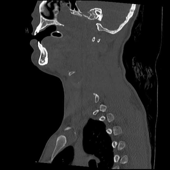 File:Atlanto-occipital dissociation (Traynelis type 1), C2 teardrop fracture, C6-7 facet joint dislocation (Radiopaedia 87655-104061 Sagittal bone window 22).jpg