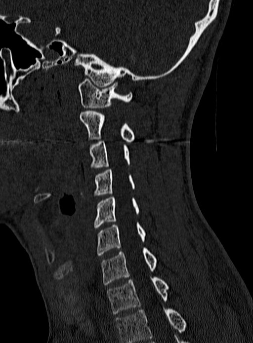 Atlantoaxial subluxation (Radiopaedia 44681-48450 Sagittal bone window 105).jpg