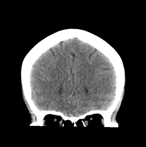 File:Atretic encephalocoele with inferior vermis hypoplasia (Radiopaedia 30443-31107 Coronal non-contrast 12).jpg