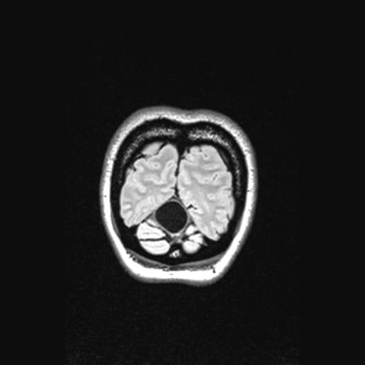 Atretic encephalocoele with inferior vermis hypoplasia (Radiopaedia 30443-31108 Coronal FLAIR 25).jpg