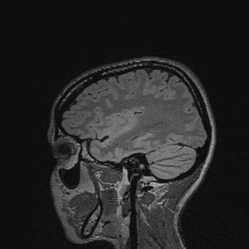 Atretic encephalocoele with inferior vermis hypoplasia (Radiopaedia 30443-31108 Sagittal FLAIR 116).jpg