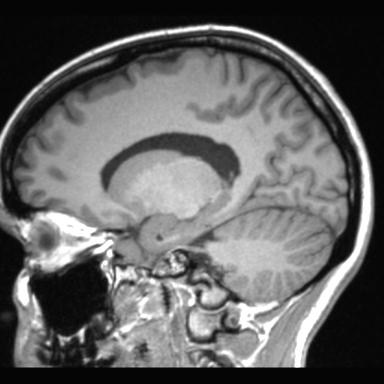 Atretic encephalocoele with inferior vermis hypoplasia (Radiopaedia 30443-31108 Sagittal T1 51).jpg