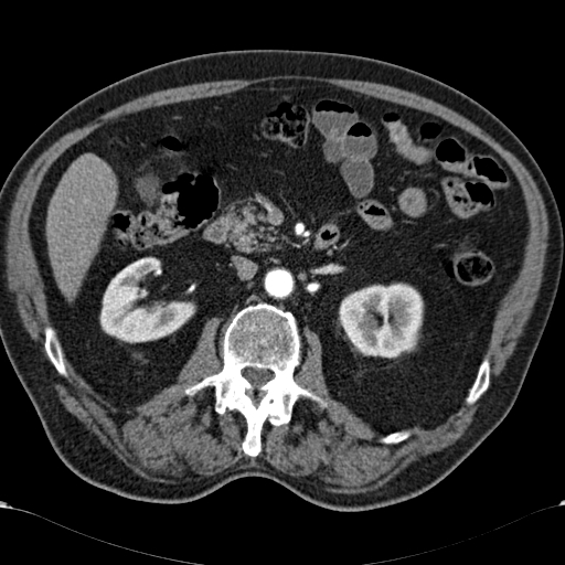 Atypical hepatocellular carcinoma (Radiopaedia 41744-44698 A 46).jpg