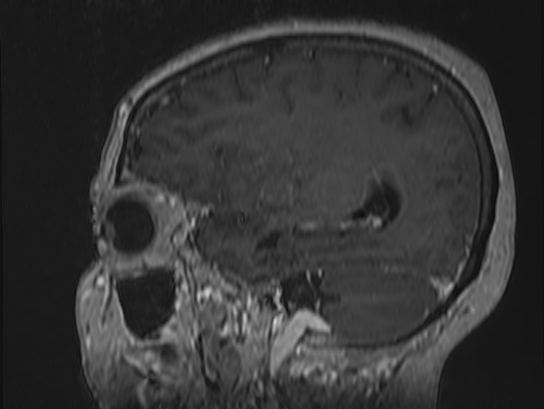 Atypical meningioma (Radiopaedia 62985-71406 Sagittal T1 C+ 22).jpg