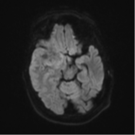 Atypical meningioma (WHO Grade II) (Radiopaedia 54742-60979 Axial DWI 39).png