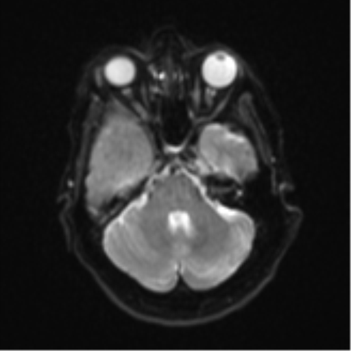 Atypical meningioma (WHO Grade II) (Radiopaedia 54742-60979 Axial DWI 8).png