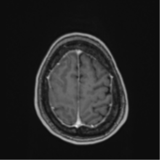 Atypical meningioma (WHO Grade II) (Radiopaedia 54742-60979 Axial T1 C+ 57).png