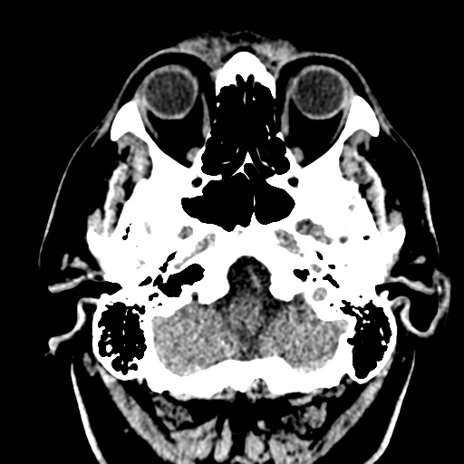 File:Atypical meningioma (WHO grade II) with brain invasion (Radiopaedia 57767-64728 Axial non-contrast 4).png
