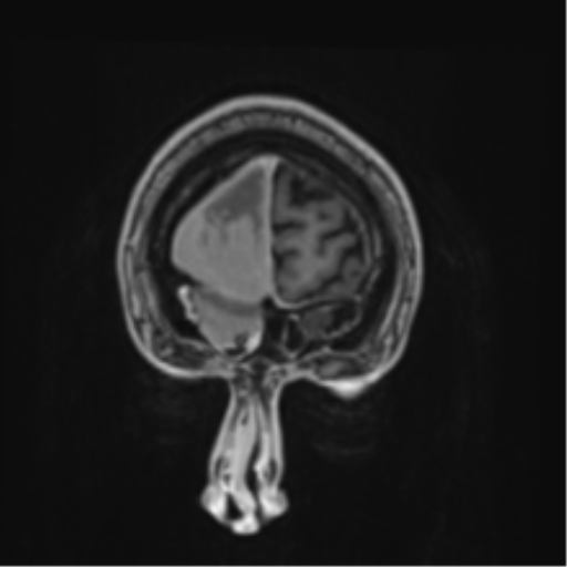 Atypical meningioma (WHO grade II) with brain invasion (Radiopaedia 57767-64729 Coronal T1 C+ 2).png