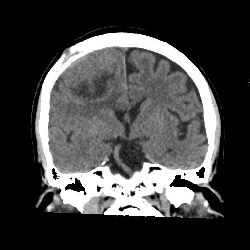 Atypical meningioma (WHO grade II) with osseous invasion (Radiopaedia 53654-59715 Coronal non-contrast 32).png