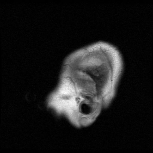 File:Atypical meningioma with skull invasion (Radiopaedia 34357-35648 Sagittal T1 1).png