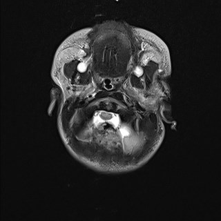 File:Atypical teratoid rhabdoid tumor (prenatal US and neonatal MRI) (Radiopaedia 59091-66388 Axial T2 5).jpg