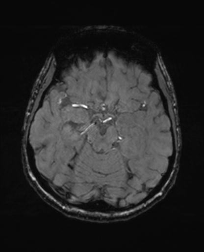 Autoimmune limbic encephalitis (Radiopaedia 30363-31005 SWI - magnitude 29).jpg