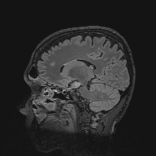 File:Autoimmune limbic encephalitis (Radiopaedia 30363-31005 Sagittal FLAIR 94).jpg