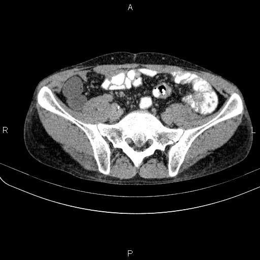 File:Autoimmune pancreatitis (Radiopaedia 84925-100431 Axial C+ delayed 66).jpg