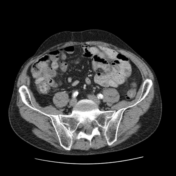 Autosomal dominant polycystic kidney disease (Radiopaedia 27851-28094 B 94).jpg