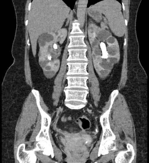 Autosomal dominant polycystic kidney disease (Radiopaedia 38189-40194 Coronal C+ delayed 61).jpg