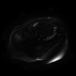 Autosomal dominant polycystic kidney disease (Radiopaedia 50259-55611 Axial DWI 107).jpg