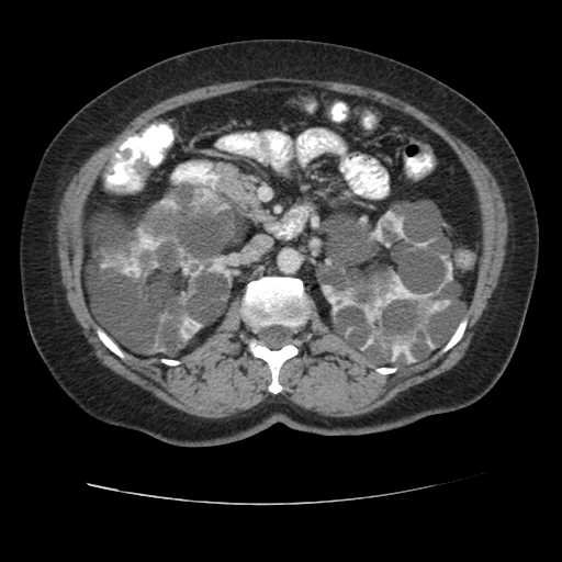 Autosomal dominant polycystic kidney disease with hepatic involvement (Radiopaedia 32693-33662 B 33).jpg