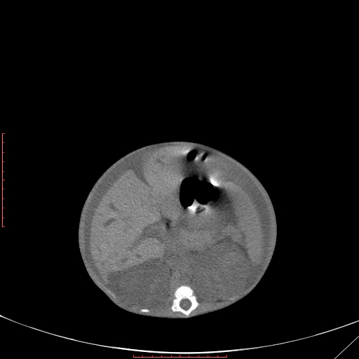 File:Autosomal recessive polycystic kidney disease associated with Caroli disease (Radiopaedia 61932-69984 Axial non-contrast 174).jpg