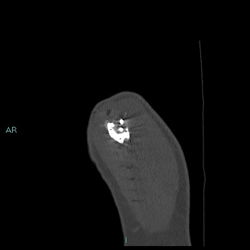 Avascular necrosis after fracture dislocations of the proximal humerus (Radiopaedia 88078-104655 Sagittal bone window 7).jpg