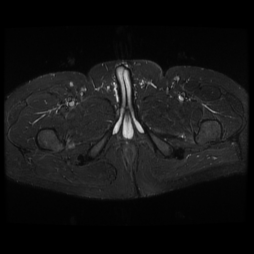 File:Avascular necrosis of the hip (Radiopaedia 61503-69465 Axial STIR 27).jpg