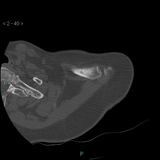 File:Avascular necrosis of the shoulder - Cruess stage I (Radiopaedia 77674-89887 Axial bone window 10).jpg