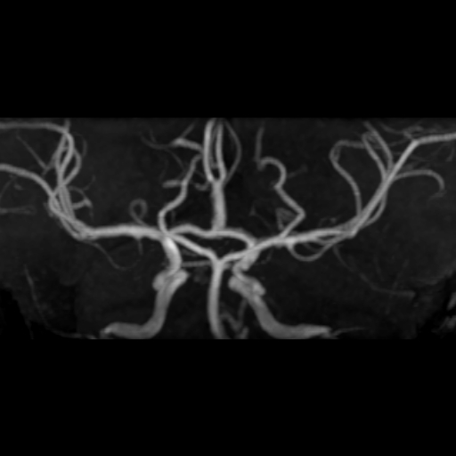 File:Azygos anterior cerebral artery (Radiopaedia 17059-16756 MRA 5).jpg