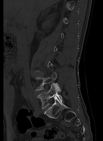 File:Baastrup syndrome (Radiopaedia 64891-73838 Sagittal bone window 1).jpg