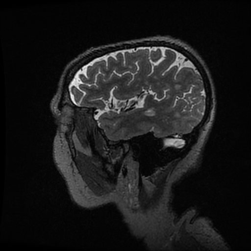 Balo concentric sclerosis (Radiopaedia 53875-59982 Sagittal 3D FSE 50).jpg