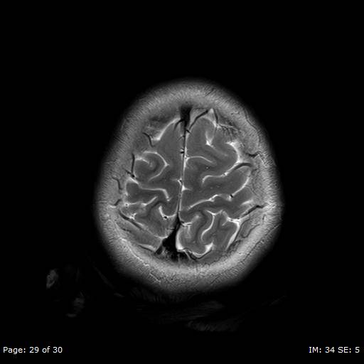 File:Balo concentric sclerosis (Radiopaedia 61637-69636 Axial T2 29).jpg