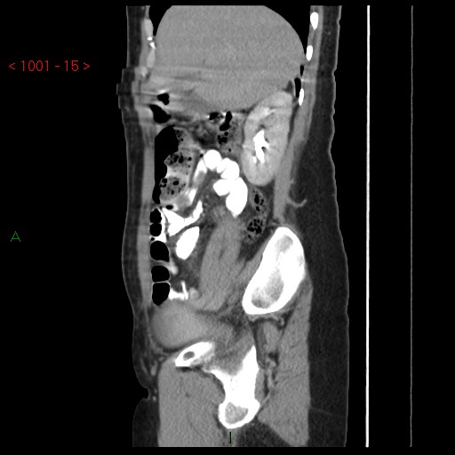 File:Bartholin gland cyst (Radiopaedia 54904-61181 Sagittal C+ delayed 15).jpg