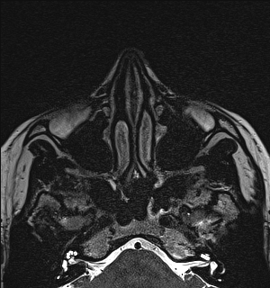 Basal cell carcinoma - nasal region (Radiopaedia 70292-80365 Axial Gradient Echo 37).jpg