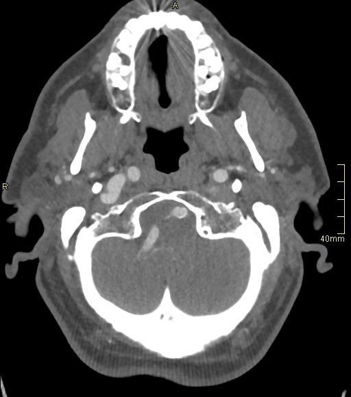 Basilar artery aneurysm (Radiopaedia 56261-62932 A 38).jpg