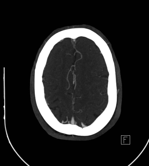 Basilar artery thrombosis (Radiopaedia 26986-27163 A 68).jpg