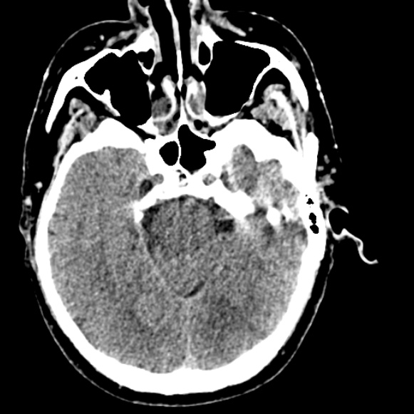 File:Basilar artery thrombosis (Radiopaedia 53351-59333 Axial non-contrast 47).jpg