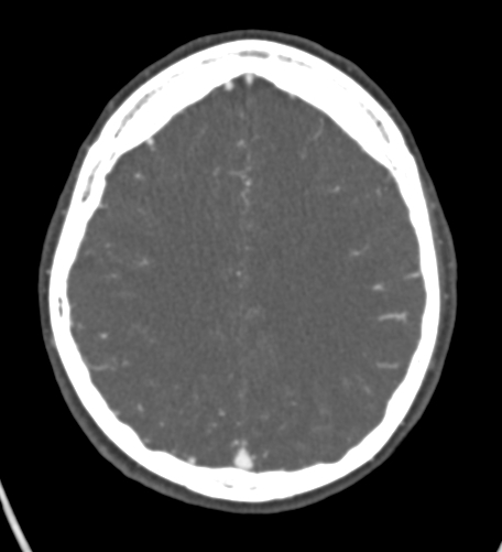 Basilar tip aneurysm with coiling (Radiopaedia 53912-60086 A 107).jpg