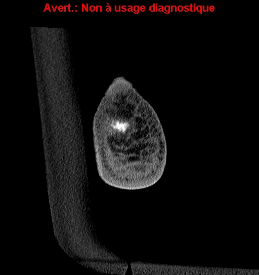 Baxter neuropathy (Radiopaedia 25988-26125 Coronal non-contrast 59).jpg