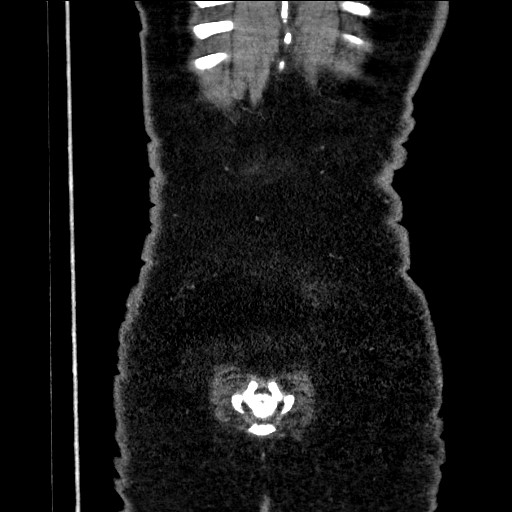 Benign leiomyoma with hydropic features (Radiopaedia 89250-106130 B 105).jpg