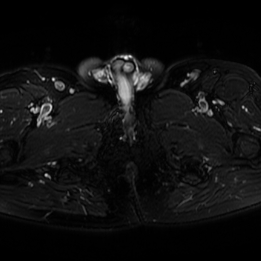 File:Benign prostatic nodular hyperplasia (Radiopaedia 16917-16634 Axial T2 fat sat 20).jpg