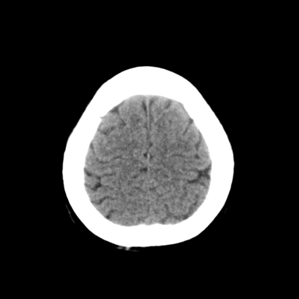 File:Bilateral PCA territory infarction - different ages (Radiopaedia 46200-50591 Axial non-contrast 20).jpg