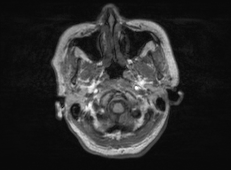 File:Bilateral PCA territory infarction - different ages (Radiopaedia 46200-51784 Axial T1 346).jpg
