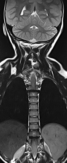 File:Bilateral Sprengel deformity with Klippel-Feil syndrome (Radiopaedia 66395-75650 F 8).jpg