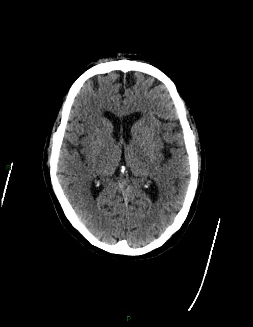 Bilateral acute middle cerebral artery territory infarcts (Radiopaedia 77319-89401 Axial non-contrast 44).jpg